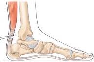 rupture tendon d'Achille Dr Siegler Marseille